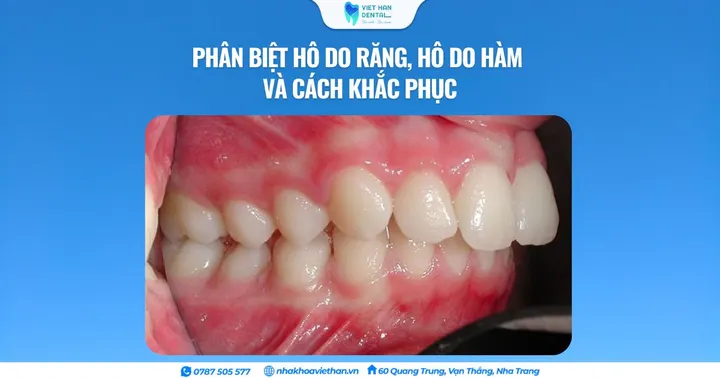 Phân biệt hô do răng, hô do hàm và cách khắc phục