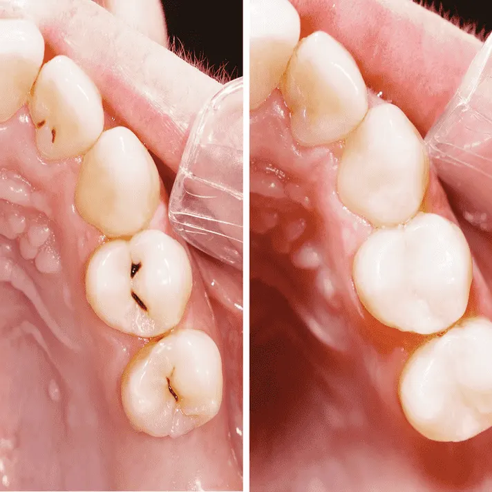 Trám răng sẽ là phương pháp điều trị để khắc phục sâu răng cho bà bầu