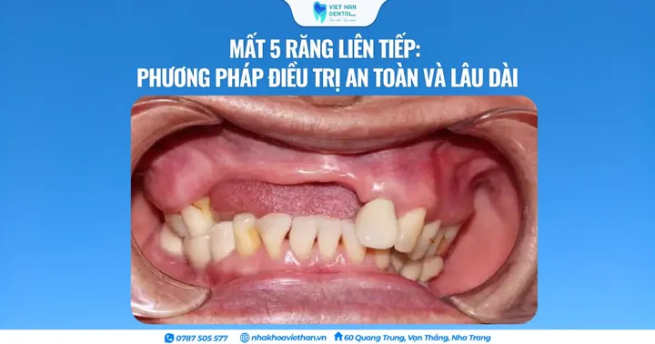 Mất 5 răng liên tiếp: Phương pháp điều trị an toàn và lâu dài