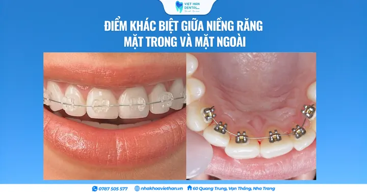 Điểm khác biệt giữa niềng răng mặt trong và mặt ngoài