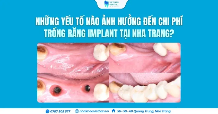 Những yếu tố nào ảnh hưởng đến chi phí trồng răng Implant tại Nha Trang?