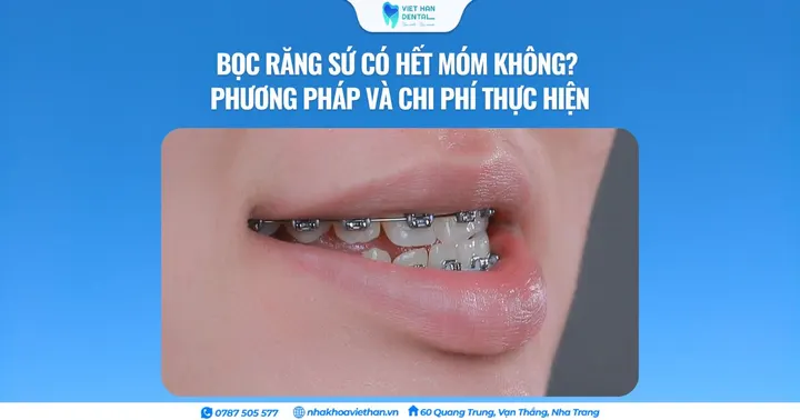 Bọc răng sứ có hết móm không? Phương pháp và chi phí thực hiện