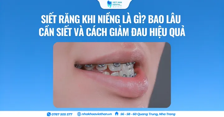 Siết răng khi niềng là gì? Bao lâu cần siết và cách giảm đau hiệu quả