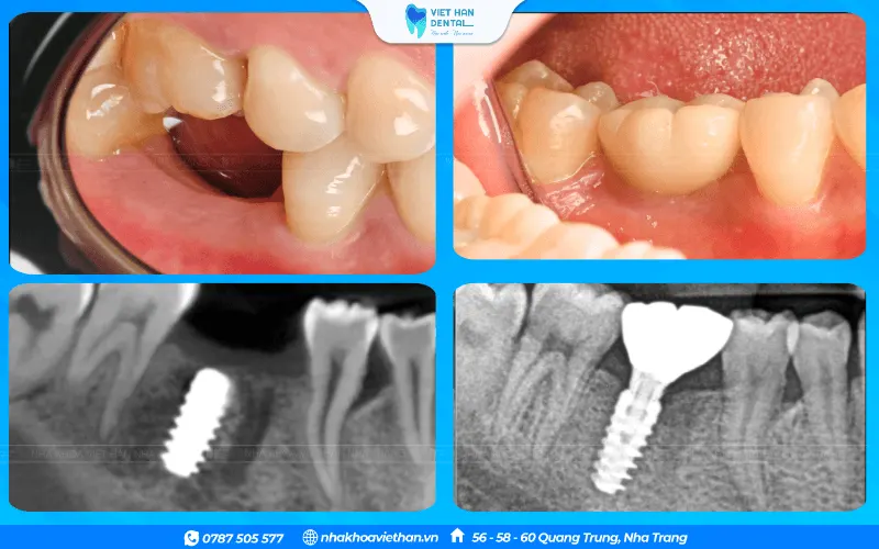 Dental implant post