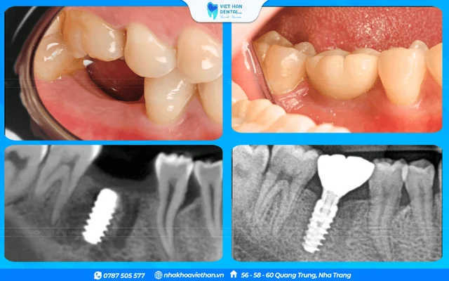 Trụ Implant của Bác sĩ Lê Châu Hưng Thịnh