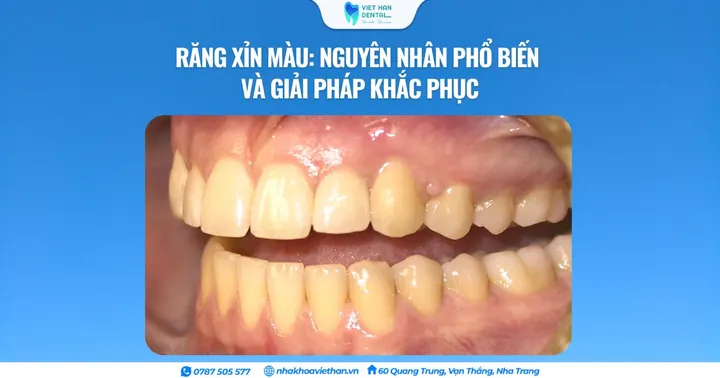 Răng xỉn màu: Nguyên nhân phổ biến và giải pháp khắc phục
