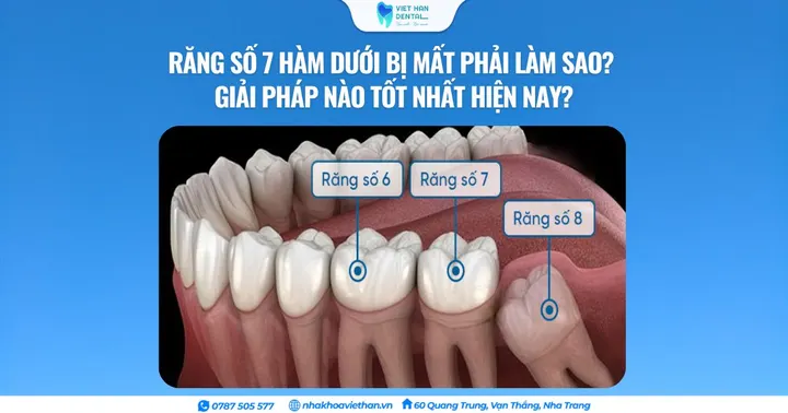 Răng số 7 hàm dưới bị mất phải làm sao? Giải pháp nào tốt nhất hiện nay?