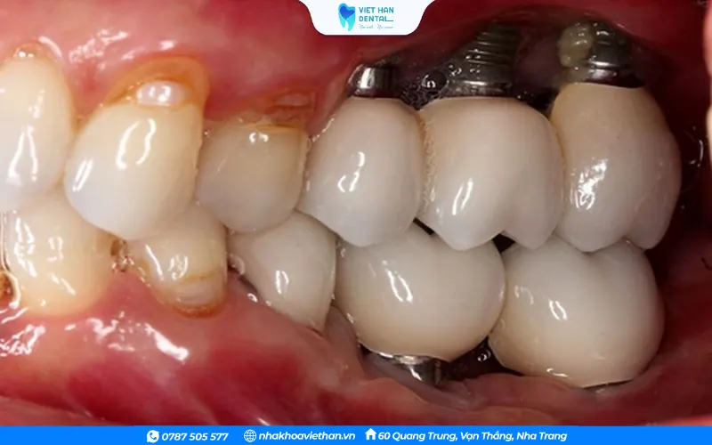 Dùng Implant kém chất lượng là một trong những nguyên nhân dẫn đến răng Implant bị lung lay