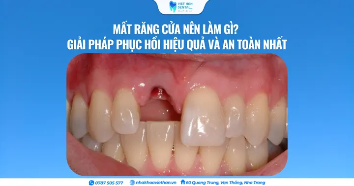 Mất răng cửa nên làm gì? Giải pháp phục hồi hiệu quả và an toàn nhất