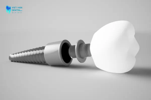 Sau khi tích hợp hoàn chỉnh, Implant Neodent tạo thành một chân răng chắc chắn