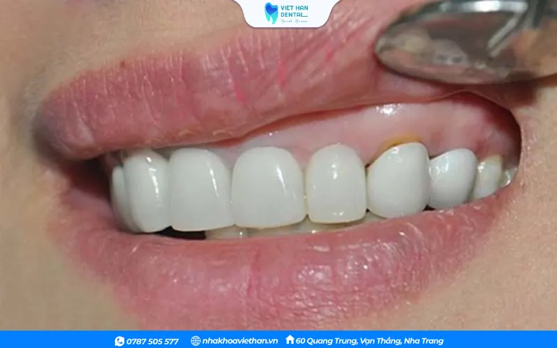Sưng nướu quanh răng bọc sứ