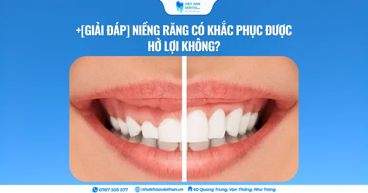 [Giải đáp] Niềng răng có khắc phục được hở lợi không?