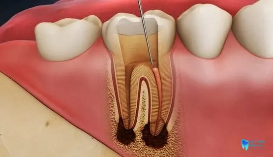 hình ảnh răng hư cần điều trị tủy