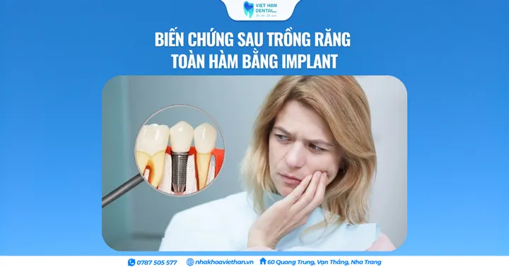 Biến chứng sau trồng răng toàn hàm bằng Implant