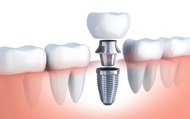 Dental implant post
