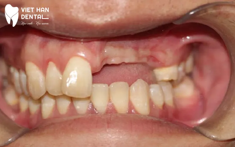 Mất răng lâu ngày dẫn đến tiêu xương hàm