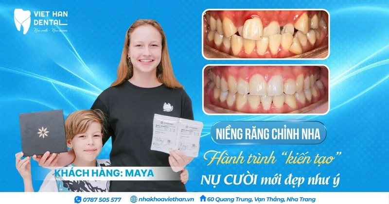 KHÁCH HÀNG NIỀNG RĂNG CHỈNH NHA – Hình 1