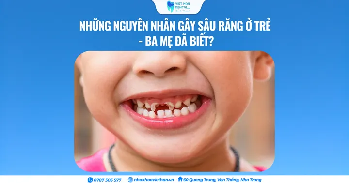 Những nguyên nhân gây sâu răng ở trẻ – Ba mẹ đã biết?