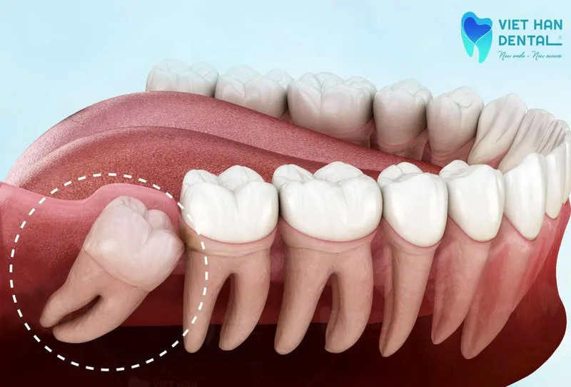 Răng khôn mọc lệch ảnh hưởng đến răng số 7