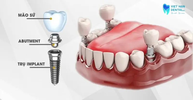 Cấu tạo của răng Implant