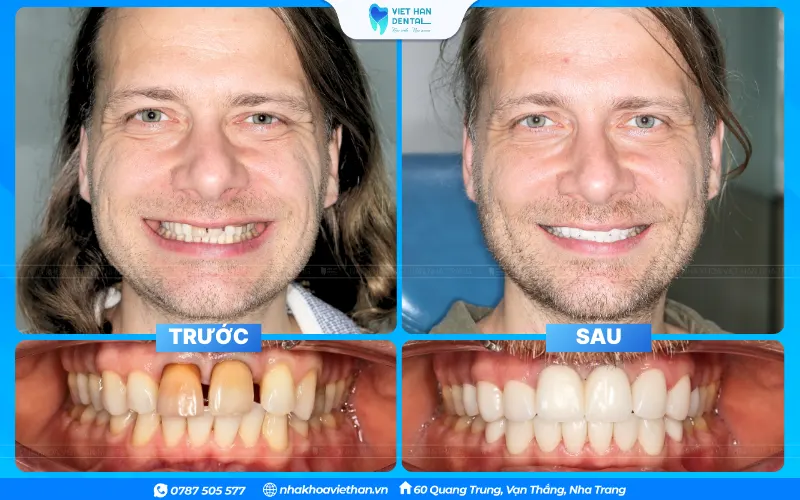 Before and after photos of a patient who received orthodontic treatment at Viet Han Dental Clinic.