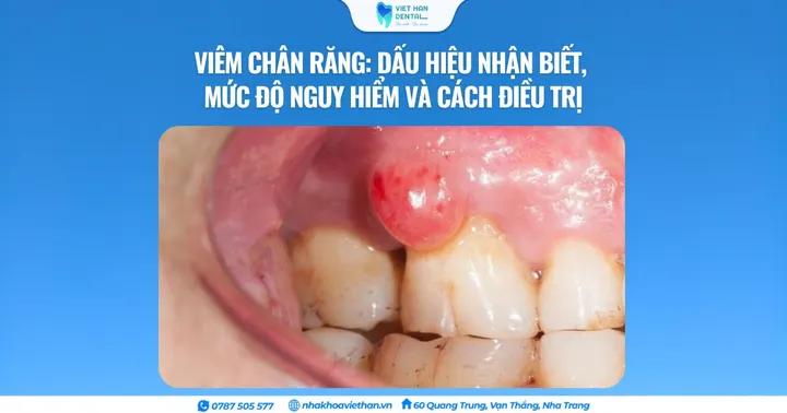 Viêm chân răng: Dấu hiệu nhận biết, mức độ nguy hiểm và cách điều trị