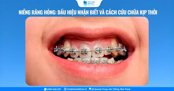 Niềng răng hỏng: Dấu hiệu nhận biết và cách cứu chữa kịp thời