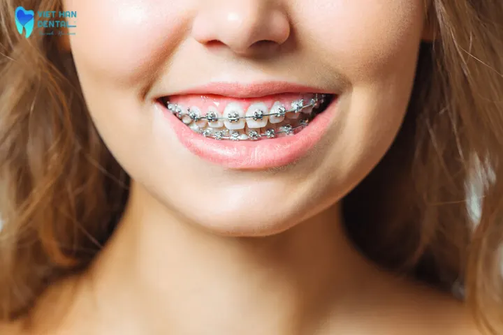 Đâu là những lợi ích của việc niềng răng?