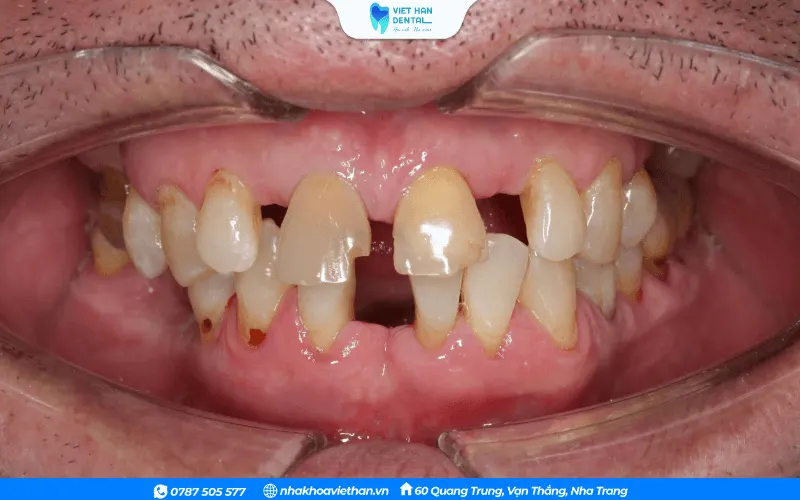 Tình trạng mất nhiều răng