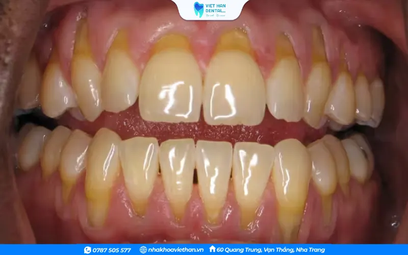 Tình trạng răng bị tụt lợi