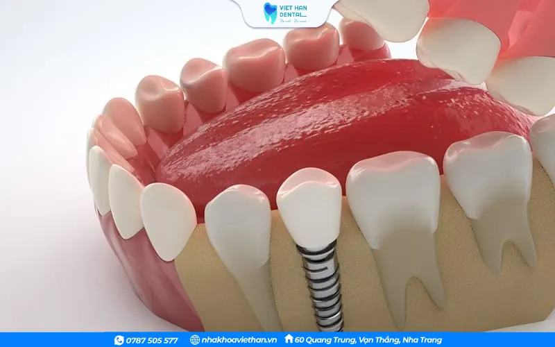 Trụ Implant