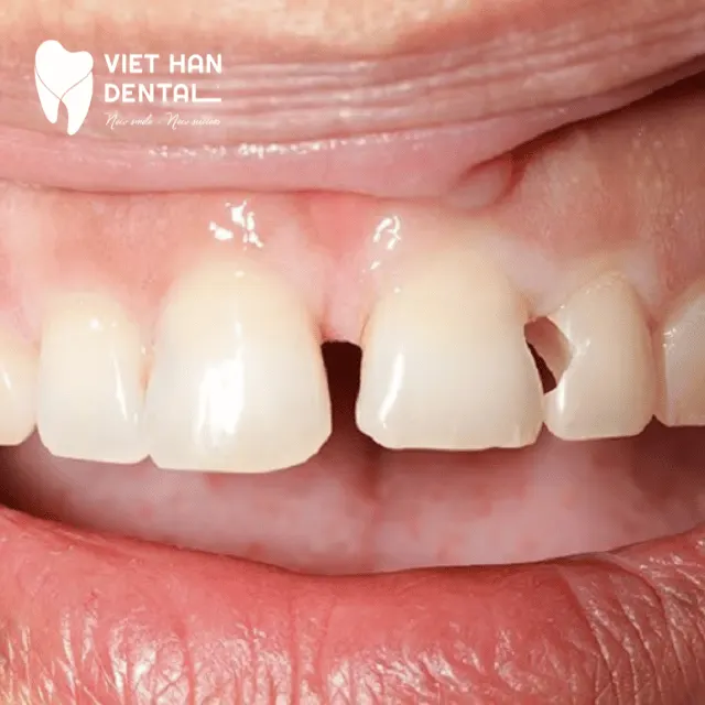 Những trường hợp có thể làm răng sứ