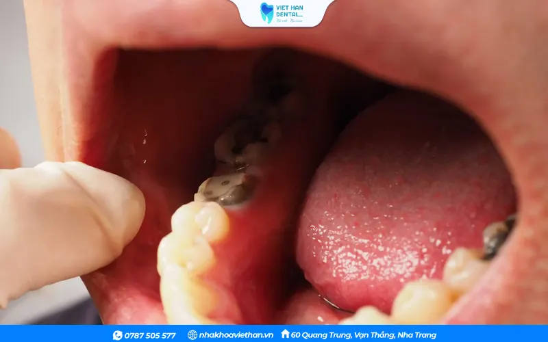 Răng cấm bị sâu, mẻ hoặc vỡ lớn không thể trám được