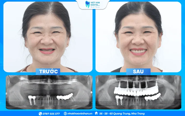 Cô Võ Thị Hoàng Yến trước và sau trồng răng Implant