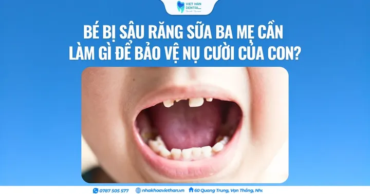 Bé bị sâu răng sữa ba mẹ cần làm gì để bảo vệ nụ cười của con?