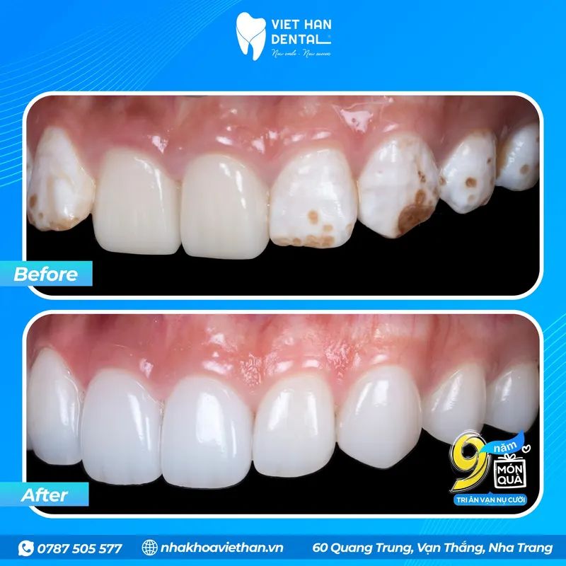 Mỹ Anh Trước Sau