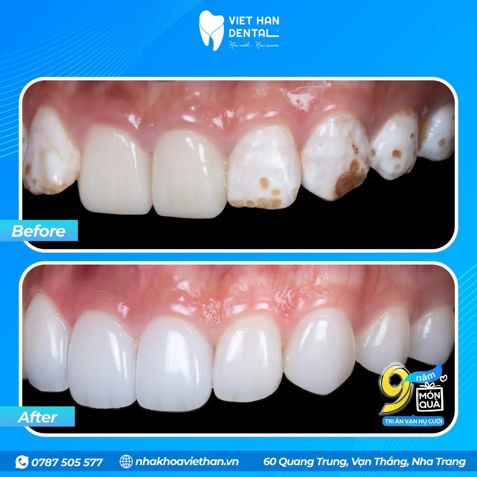 My Anh's teeth before and after cosmetic dental veneer treatment.