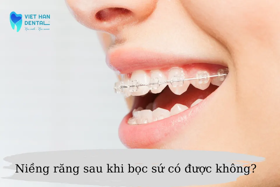 khách đeo niềng khi đang bọc sứ