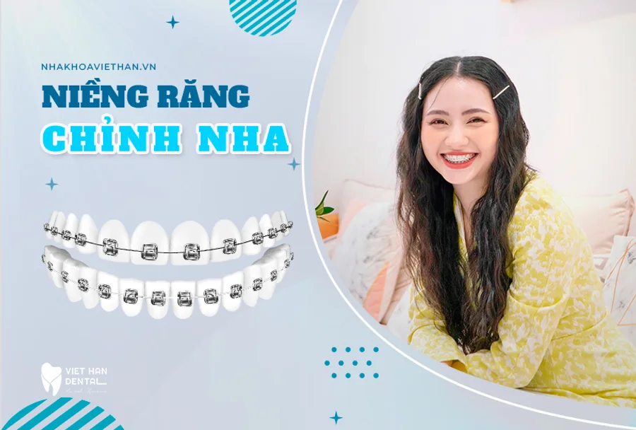 Niềng răng