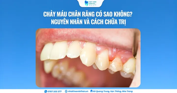 Chảy máu chân răng có sao không? Nguyên nhân và cách chữa trị