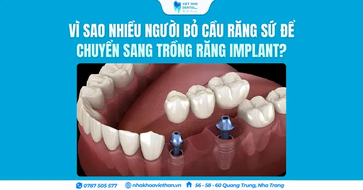 Vì sao nhiều người bỏ cầu răng sứ để chuyển sang trồng răng Implant?