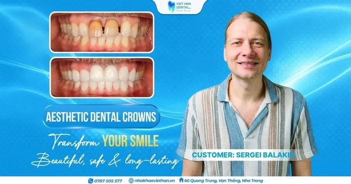 A 4,900 km Journey from Australia to Vietnam: Aesthetic Porcelain Restoration that “Healed” a Smile Lost at 18