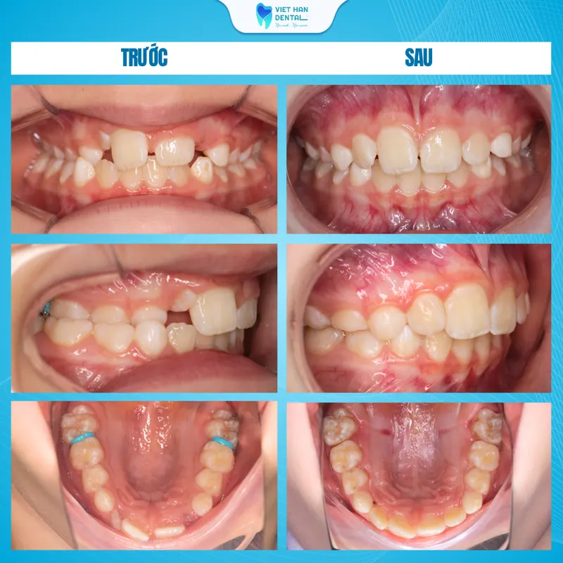 Hình ảnh răng khách hàng trước và sau khi niềng răng tăng trưởng tại Nha khoa Việt Hàn