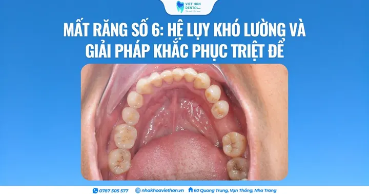 Mất răng số 6: Hệ lụy khó lường và giải pháp khắc phục triệt để