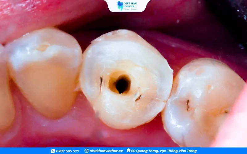 Cần phải chăm sóc răng sau khi điều trị tủy