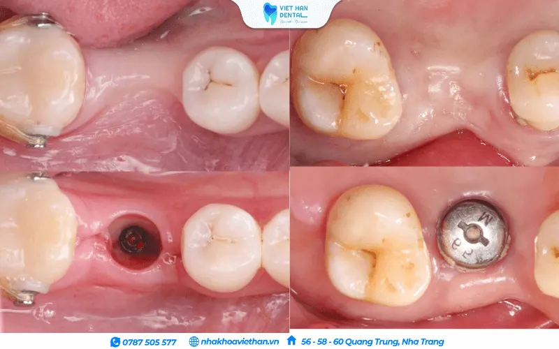 Trụ Implant giúp hạn chế tình trạng tiêu xương sau khi mất răng