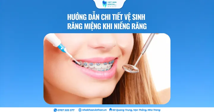 Hướng dẫn chi tiết vệ sinh răng miệng khi niềng răng