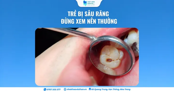 Trẻ bị sâu răng – Đừng xem nên thường