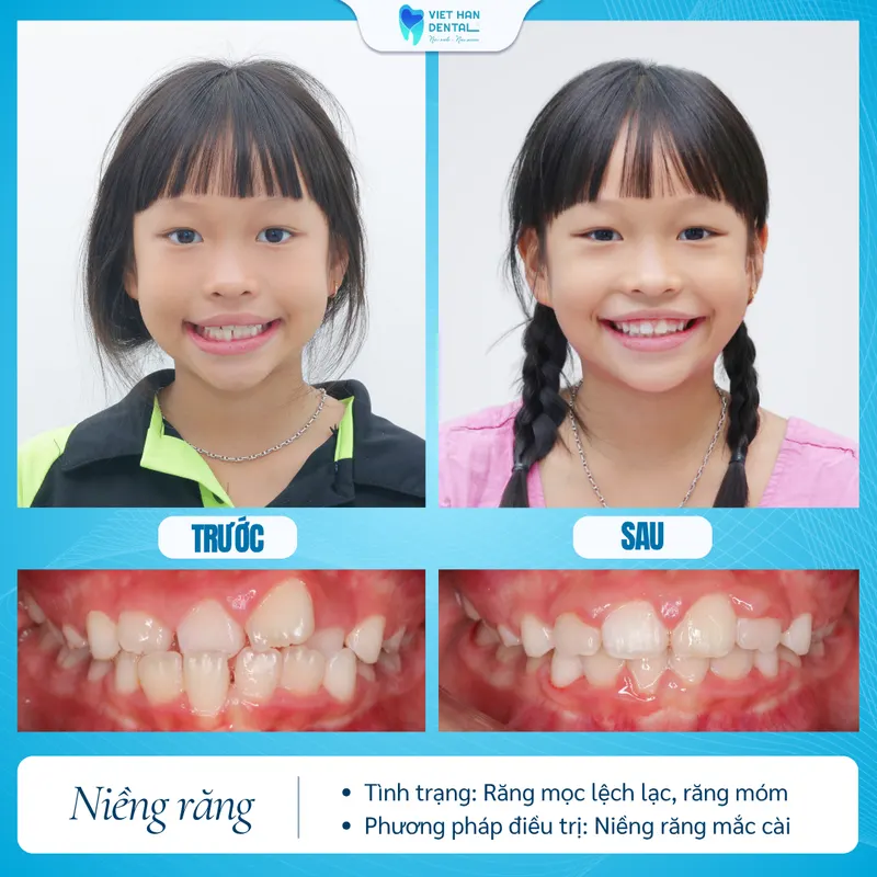 Khách hàng nhí niềng răng tăng trưởng tại Nha khoa Việt Hàn
