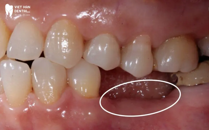 Mất răng hàm gây tiêu xương, lão hóa sớm